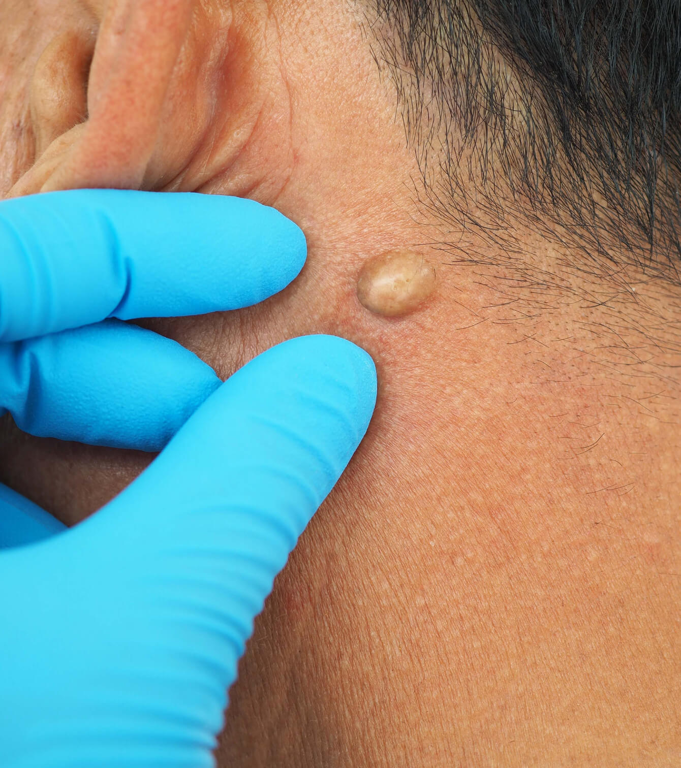 Skin Tag Removal With Registered Doctors