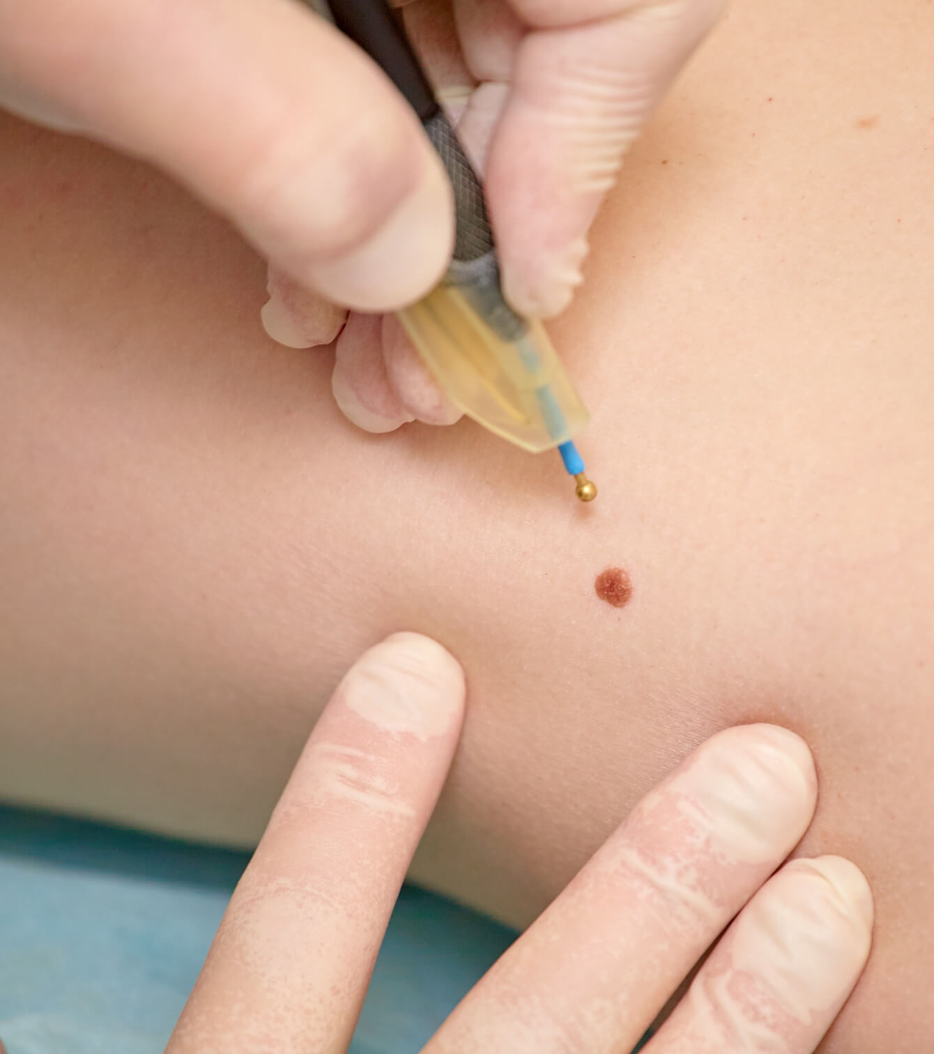 A dermatologist removes a mole from a patient